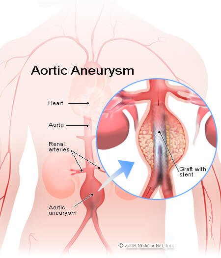aortic_aneurysm